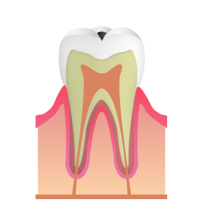 C1：初期のむし歯