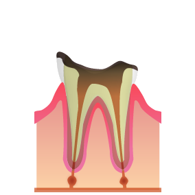 C4：末期のむし歯